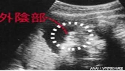 胎儿生男生女,b超怎么看出胎儿姓名