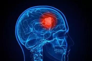 肺癌脑转移盲吃9291的成功率,肺癌转移脑膜治疗后没有癌细胞了