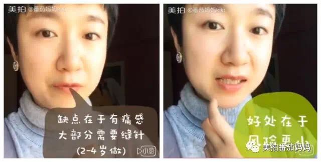 12岁孩子说话不清楚舌系带过短,2周岁8个月舌系带过短要不要剪