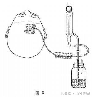 烟雾病脑内出血,烟雾病脑室出血死亡率