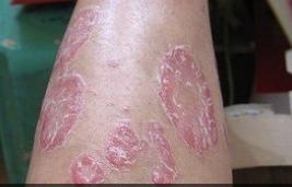 情绪不好出现皮肤病,情绪不稳定得皮肤病