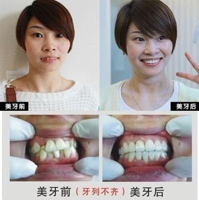 成人可以牙齿矫正,成人矫正牙齿的利与弊