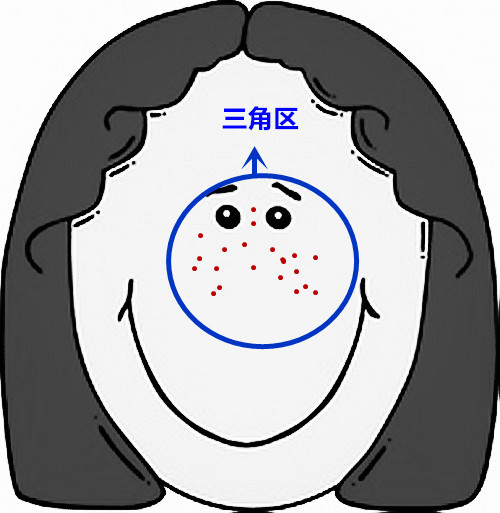 超级齐全的痘痘护理，有痘痘的妹子抓紧收藏