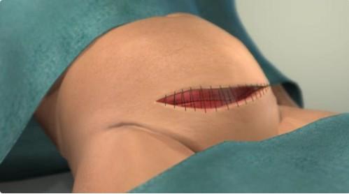 给孩子看的剖腹产手术全部流程,剖腹产手术最详细的介绍