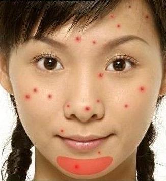 30岁后背长痘是什么原因,30岁长痘的原因和解决方法