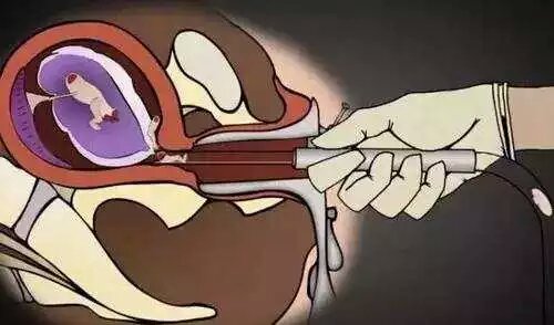 男的会接受女朋友打胎吗,你会建议你的女朋友打胎吗