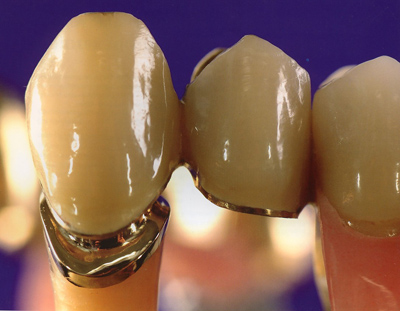 义齿怎么辨别真假,学会三招让你远离伪劣义齿