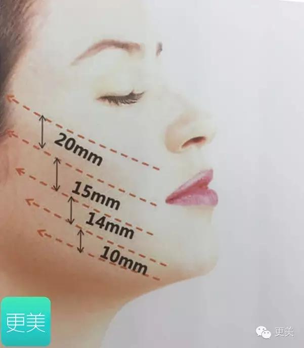 脸部缝美容线好还是普通线好,医院埋线和美容院埋线有什么差别