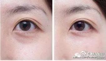 分不清是哪种黑眼圈,分不清楚是眼袋还是黑眼圈