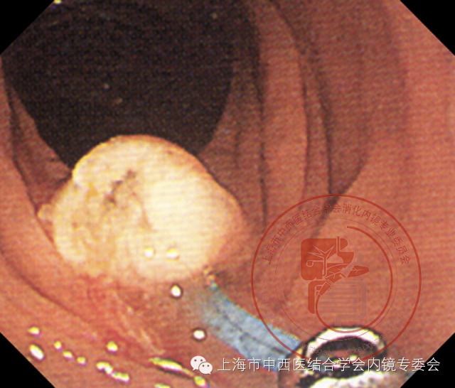 内镜套扎是什么,内镜套扎器械
