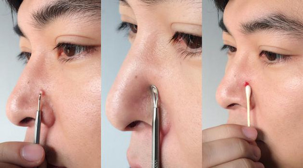 女生挤痘痘造成颅内感染,女子挤痘引起面部感染