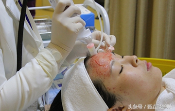 微针是什么美容项目,微针护肤可靠吗