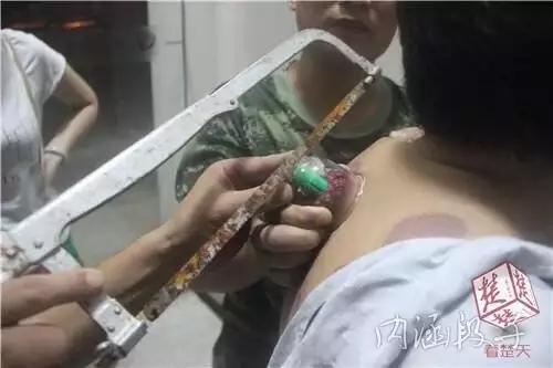 男子救人后无声离开,男子拔火罐拔不出来叫消防队
