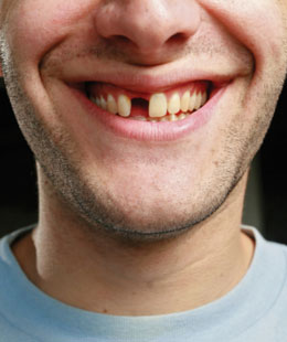 缺失下门牙可以做种植牙吗,门牙缺失不想种植牙怎么办