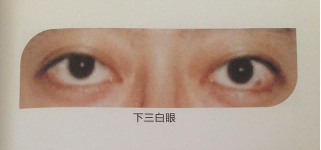 “三白眼”：看到这样的眼睛，男子慌张转身便逃！