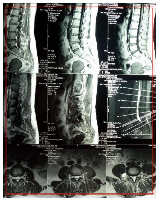 椎管内海绵状血管瘤都要手术吗？