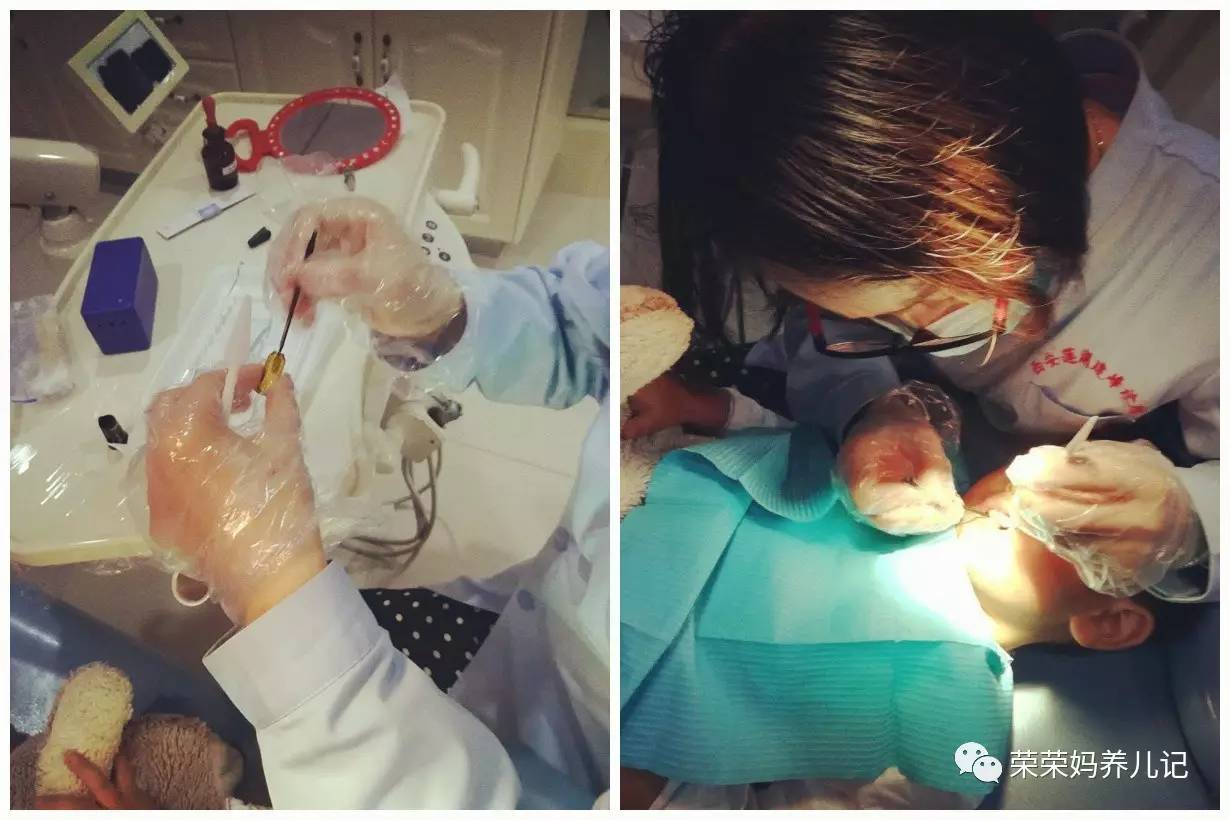 儿童涂氟前需要做口腔内窥镜吗,小孩牙齿涂氟好还是做窝沟封闭好