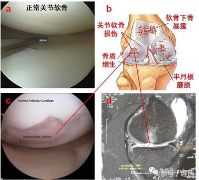 膝关节增生与滑膜炎的区别,关节炎滑膜炎骨质增生能治好吗