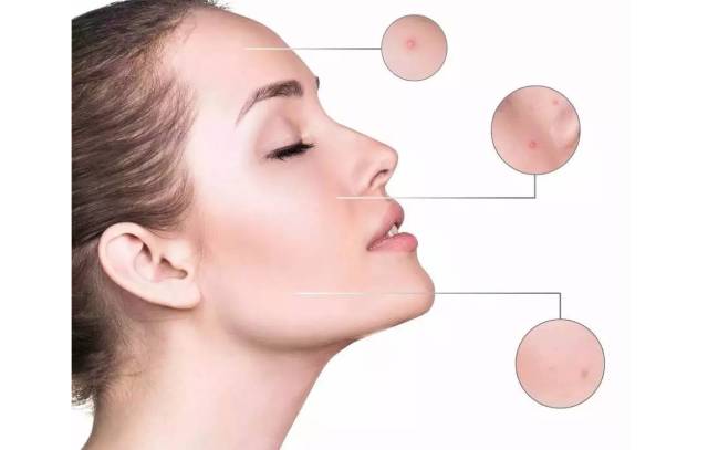 粉刺黑头去除最快方法,黑头虫怎么去除最快方法