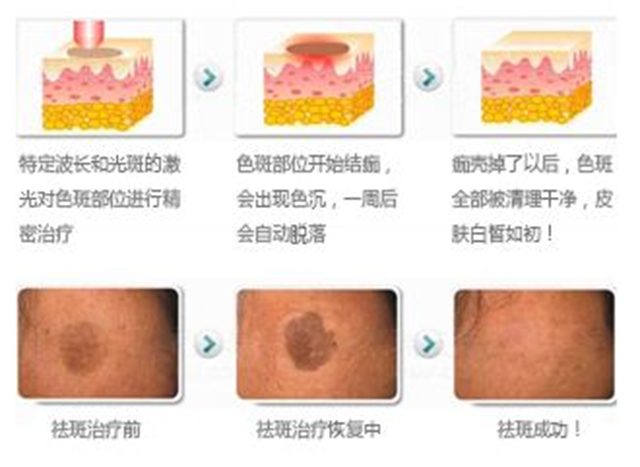 褐青色斑怎么预防,褐青色斑如何预防