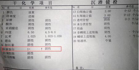 尿蛋白出现可怕吗,尿蛋白高就一定是肾病综合征吗