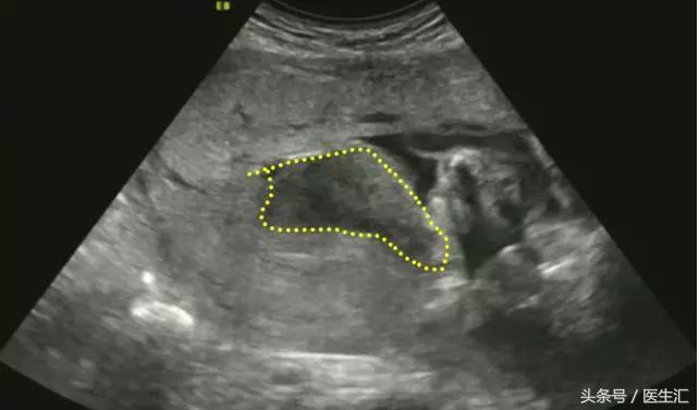 胎盘早剥病例课件,胎盘早剥的超声鉴别诊断