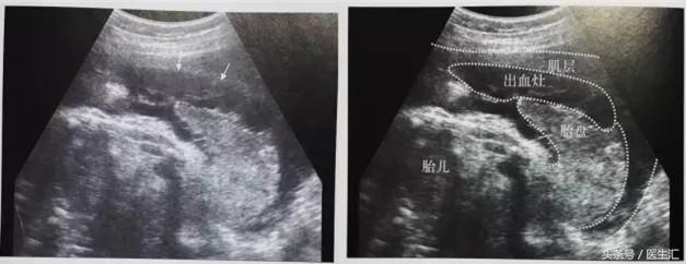 胎盘早剥病例课件,胎盘早剥的超声鉴别诊断