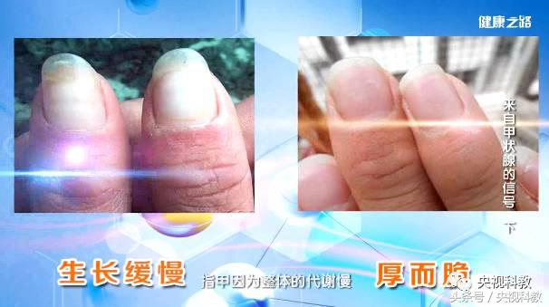 健康之路甲减,一张图自测是否有甲减