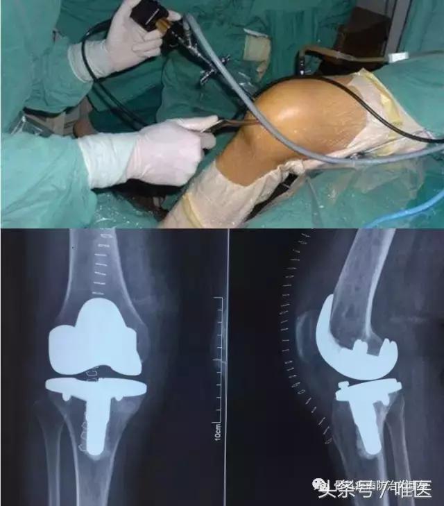 踝关节疼痛警惕四种病滑膜炎,关节炎滑膜炎的症状及治疗