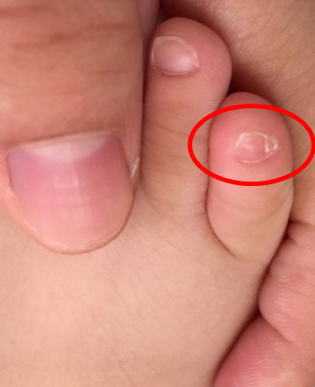 小脚趾头指甲分两半的故事,小脚趾的两半小指甲的由来