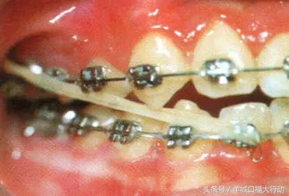 牙齿矫正过程中个别牙齿一碰就疼,牙齿矫正过程中牙缝大是正常的吗