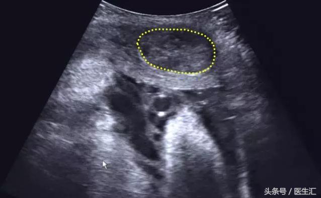 胎盘早剥是什么导致的,胎盘早剥是什么原因造成的胎儿肺炎