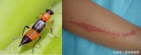 孕妇隐翅虫叮咬后皮肤溃烂,隐翅虫叮过后用蚊虫叮咬膏有效吗