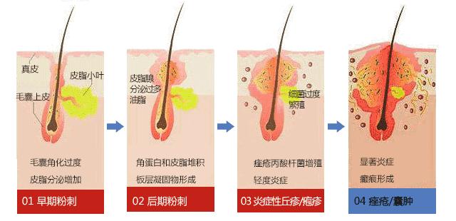 痘痘闭口一直不好,痘痘摸起来硬硬的很疼反反复复