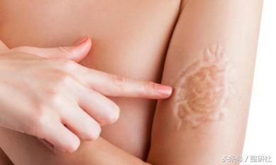 医美祛疤方法,医美祛色素疤痕