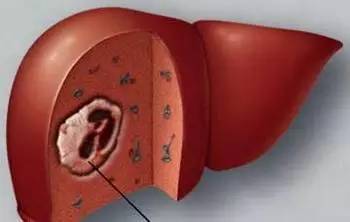 39岁肝癌去世的年轻人,29岁著名女歌手患上癌症