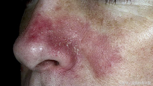 西医认为脂溢性皮炎的原因有什么,脂溢性皮炎发病年龄及发病率