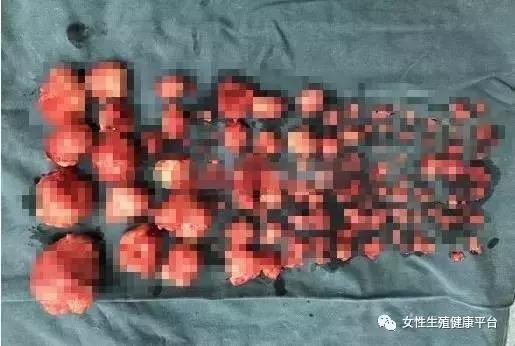 29岁女子子宫里长110颗肌瘤，长了这么多都没发现，竟是……