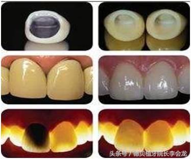 几百元一颗牙齿,几百一颗的牙贴面好吗