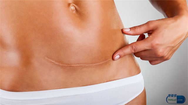 产后伤口没恢复好挂什么科,产后伤口护理