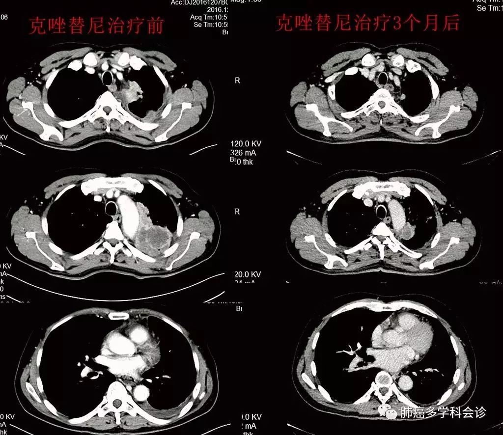 肺癌krasg12d基因突变生存期,肺癌krasg13c基因突变