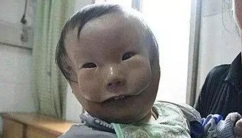 宝宝出生满脸胎记孕期注意,宝宝出生一定要戴露顶帽子吗