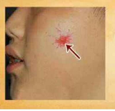 皮肤出现蜘蛛痣是不是肝硬化,皮肤出现蜘蛛