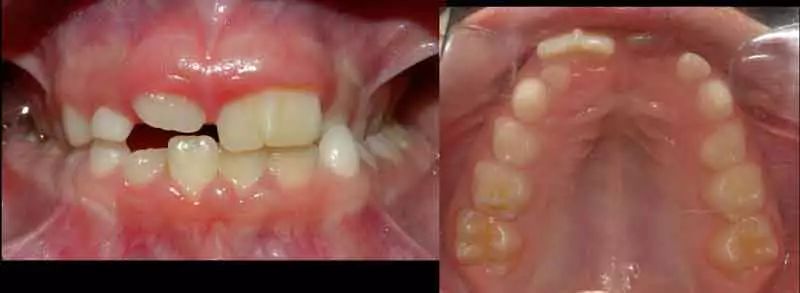 两个牙长在一起并融合了怎么办,两颗牙长在一起