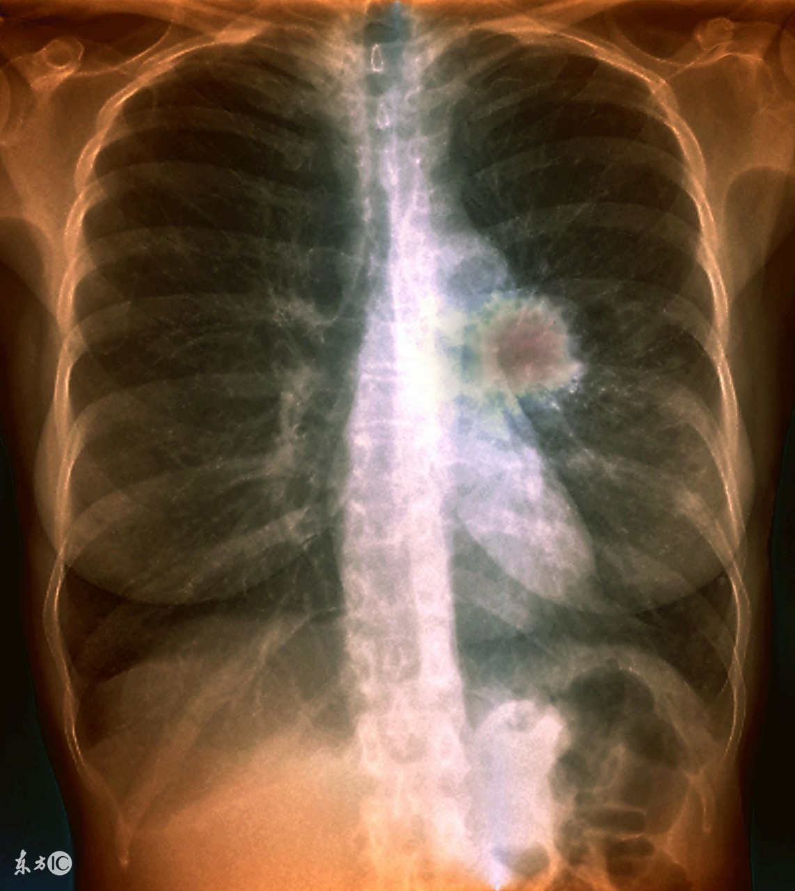 简述肺结核的药物治疗原则,肺结核治疗原则及常用药物