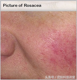 酒渣鼻玫瑰痤疮是怎么引起的,玫瑰痤疮会变成酒渣鼻吗