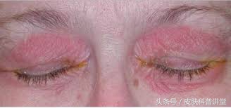 酒渣鼻玫瑰痤疮是怎么引起的,玫瑰痤疮会变成酒渣鼻吗