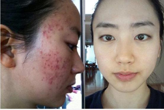 脸上痘痘硬硬的一直不消怎么办,生产后脸上痘痘不消怎么办