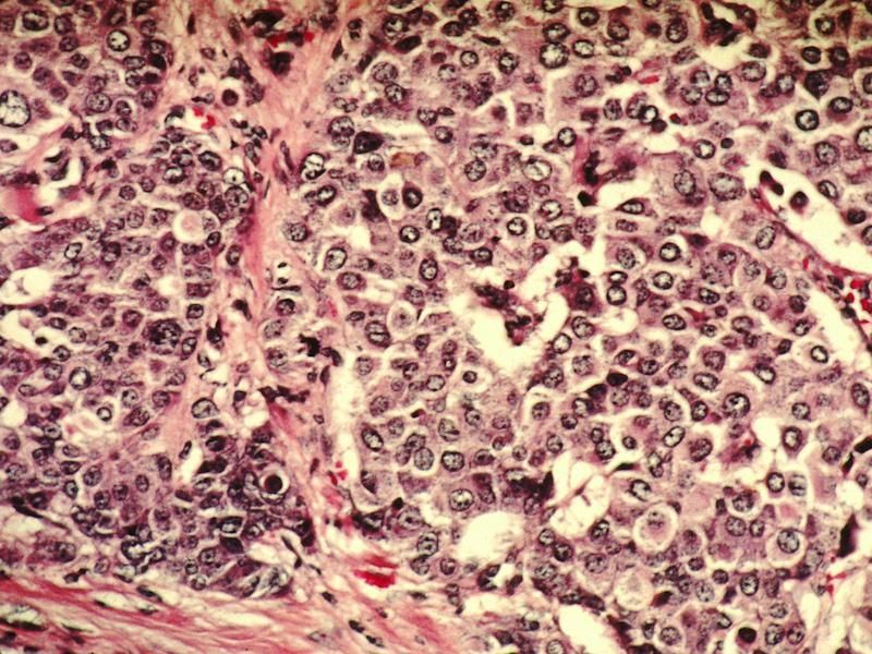 2017年国际癌症科学取得三项突破