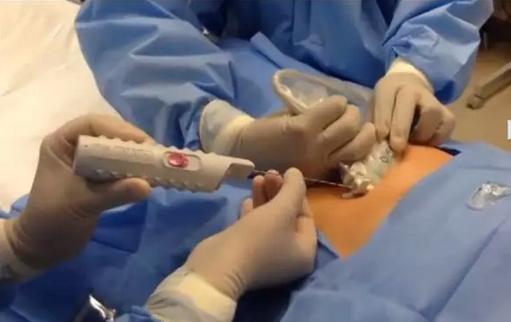 非常流行的肝硬度检查，乙肝患者为什么要做？